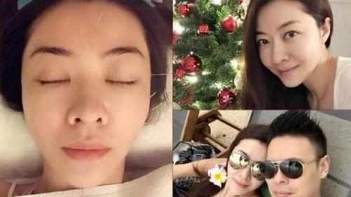 明星做针清吗,揭秘针清美容术